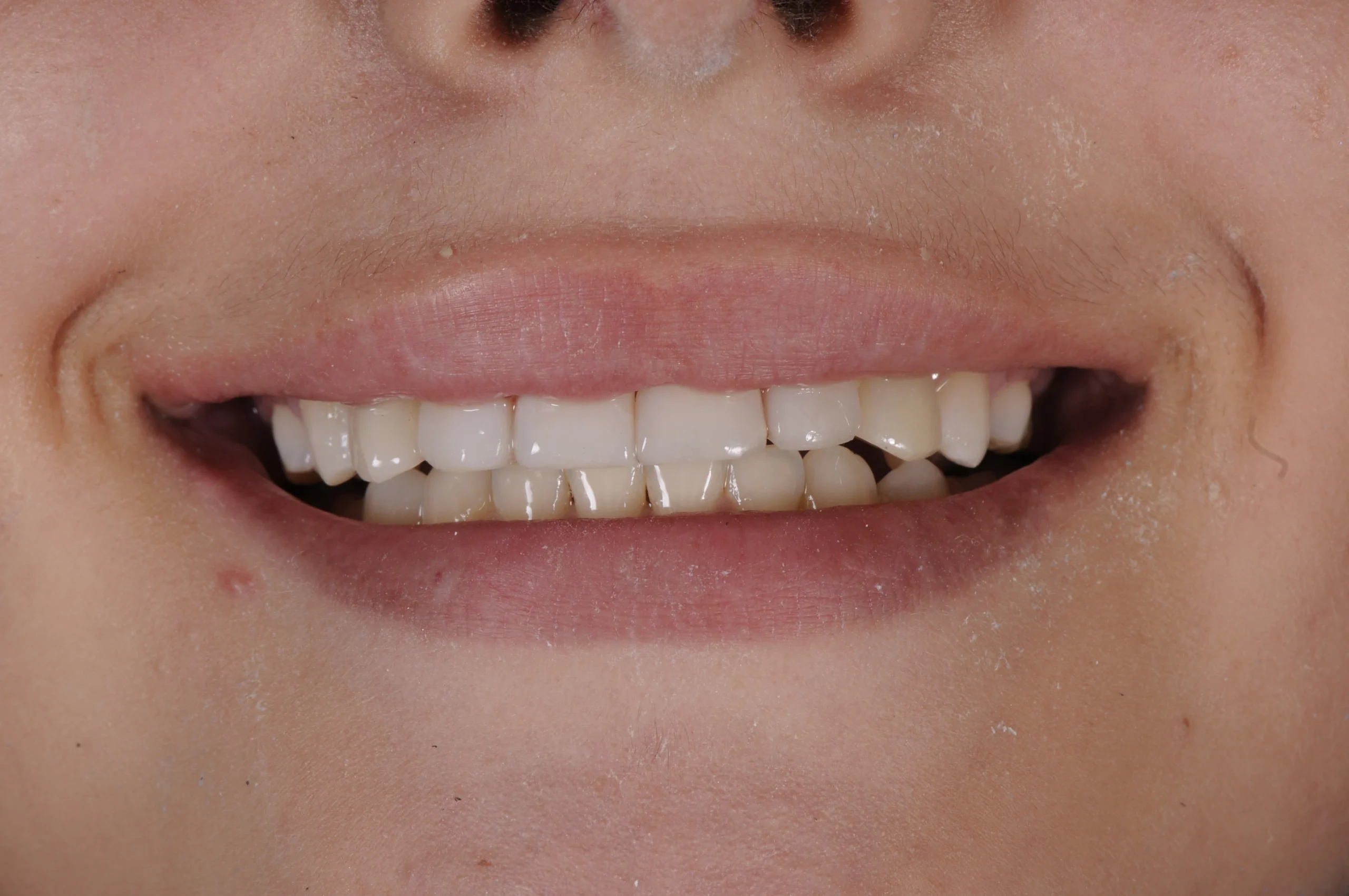 Missing Teeth After