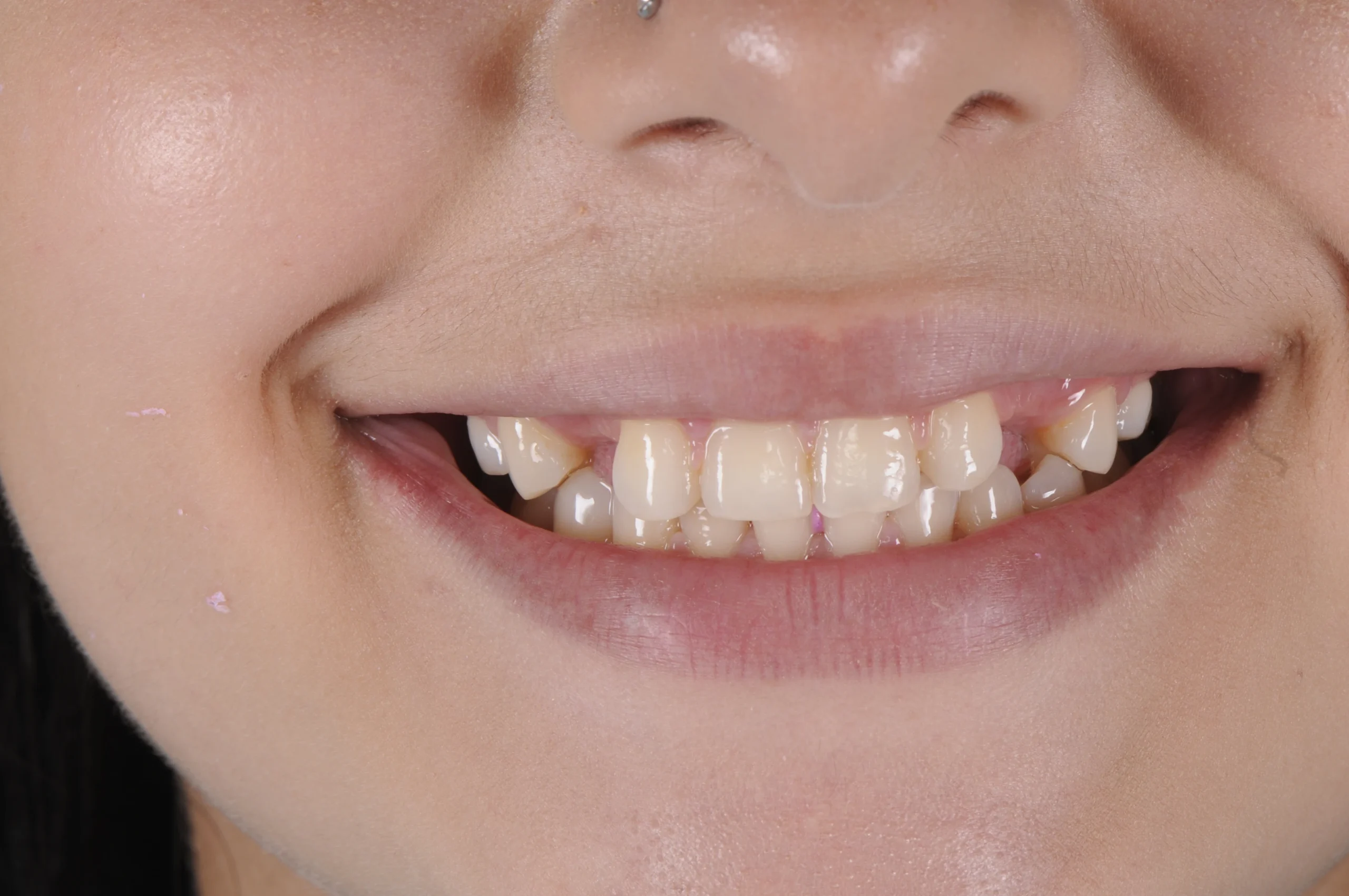 Missing Teeth Before