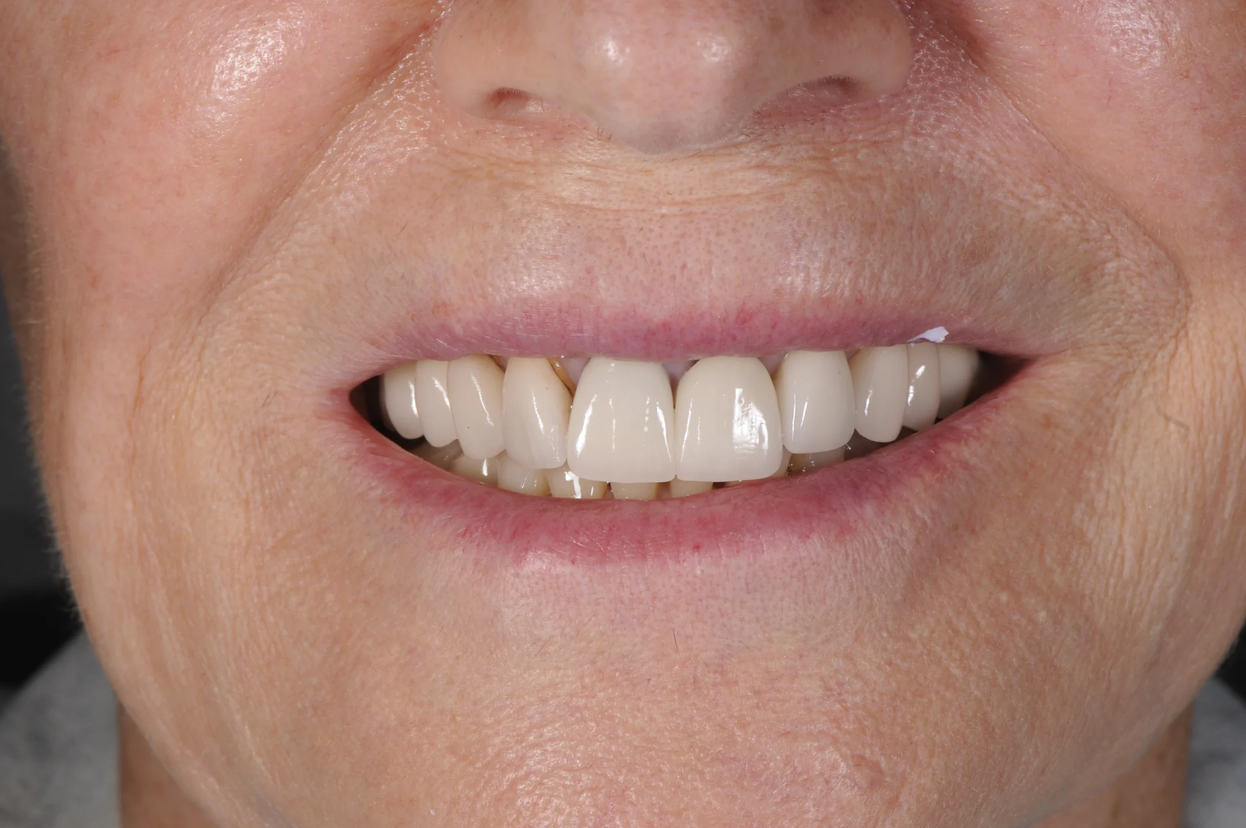 Veneers Before
