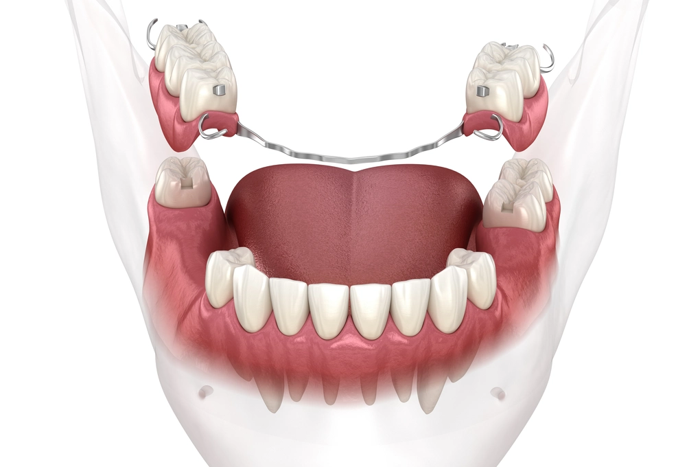 dentures partials