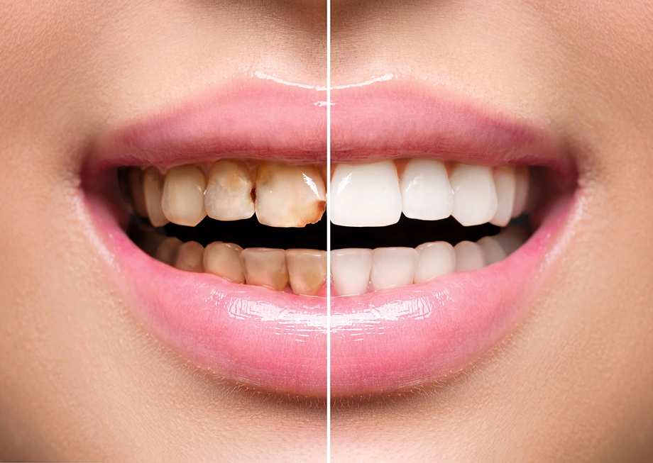 full mouth rehabilitation