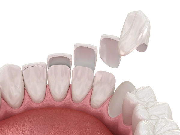 porcelain veneers